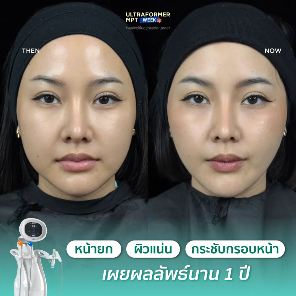 รีวิว MPT