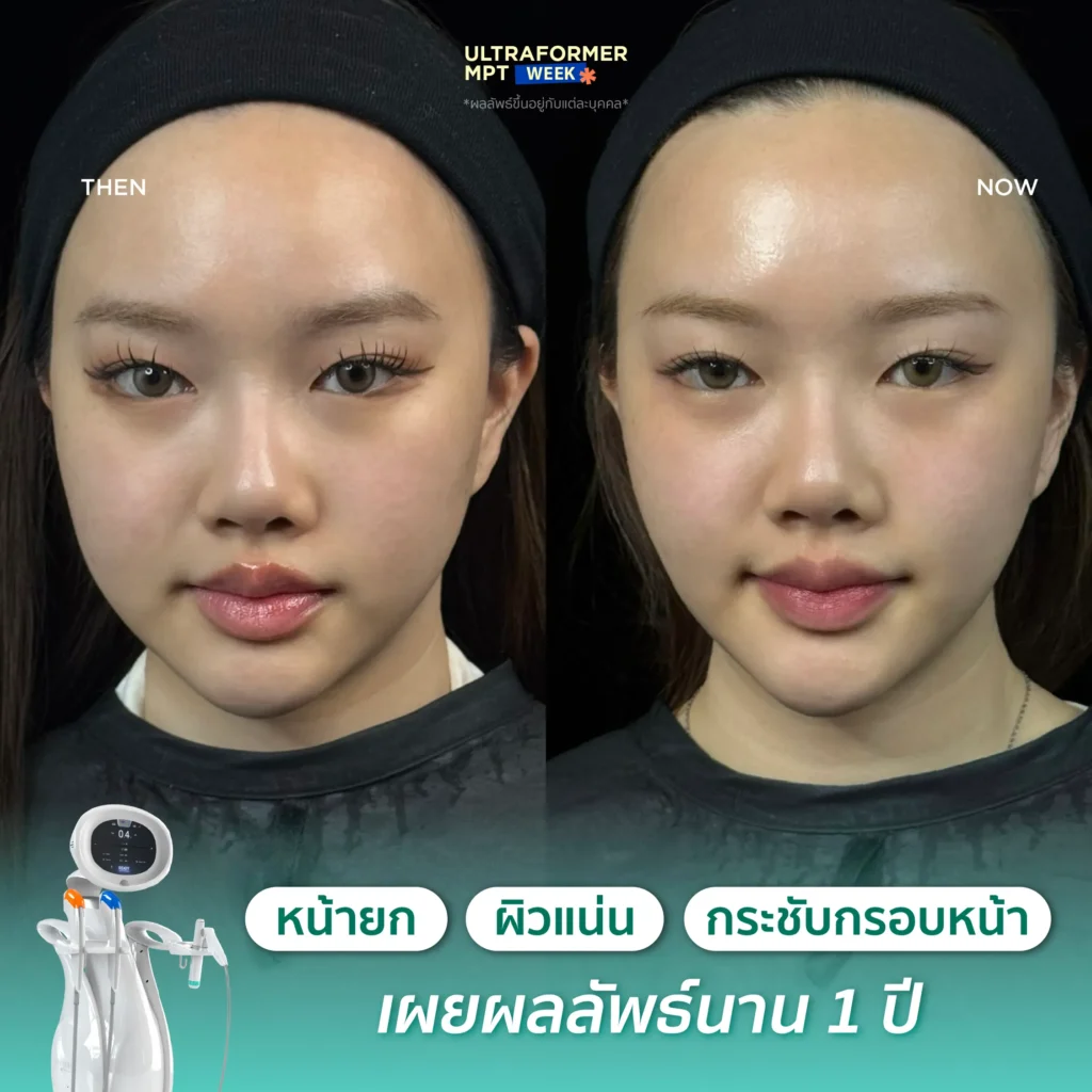 รีวิว MPT