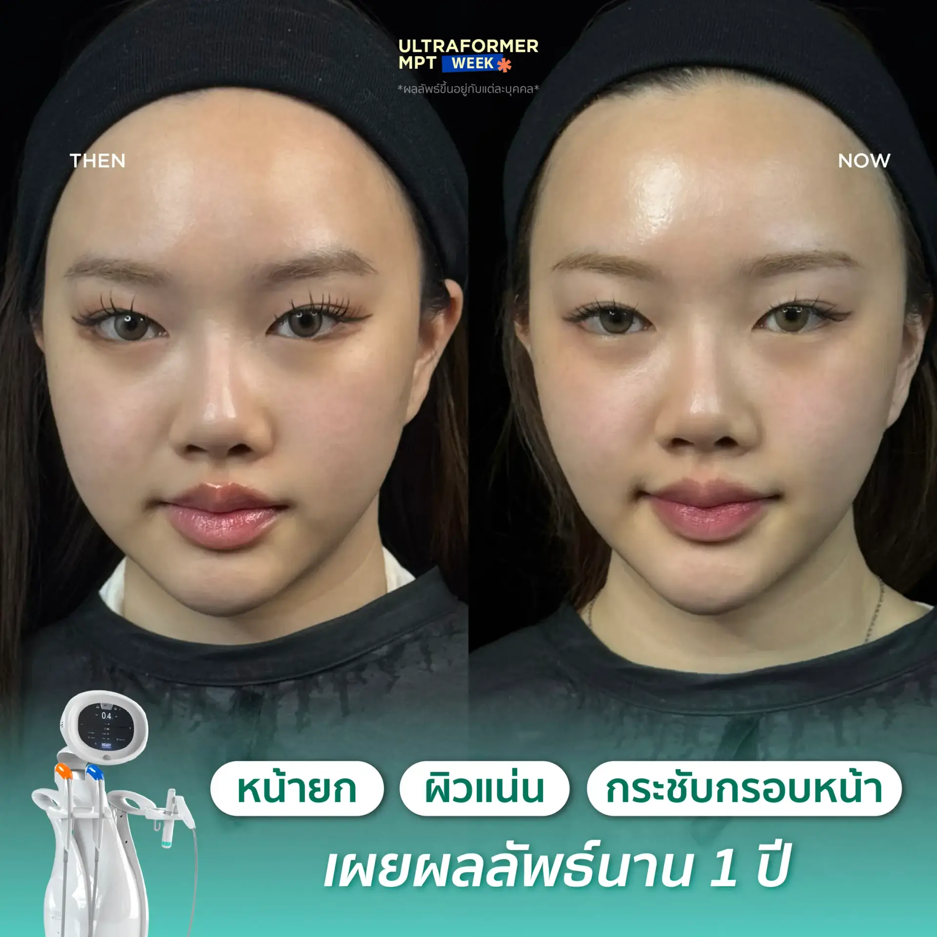 Ultraformer MPT治疗效果回顾，图4。