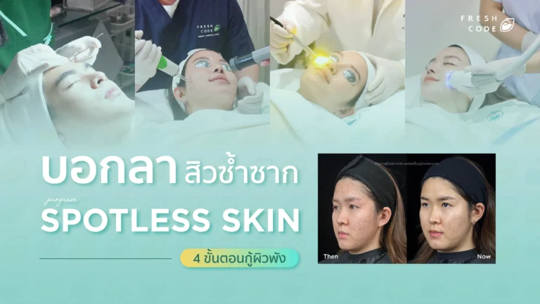 บอกลาวงจรสิวซ้ำซาก เปิด 4 ขั้นตอนกู้ผิวพัง คืนความมั่นใจด้วยโปรแกรม Spotless Skin