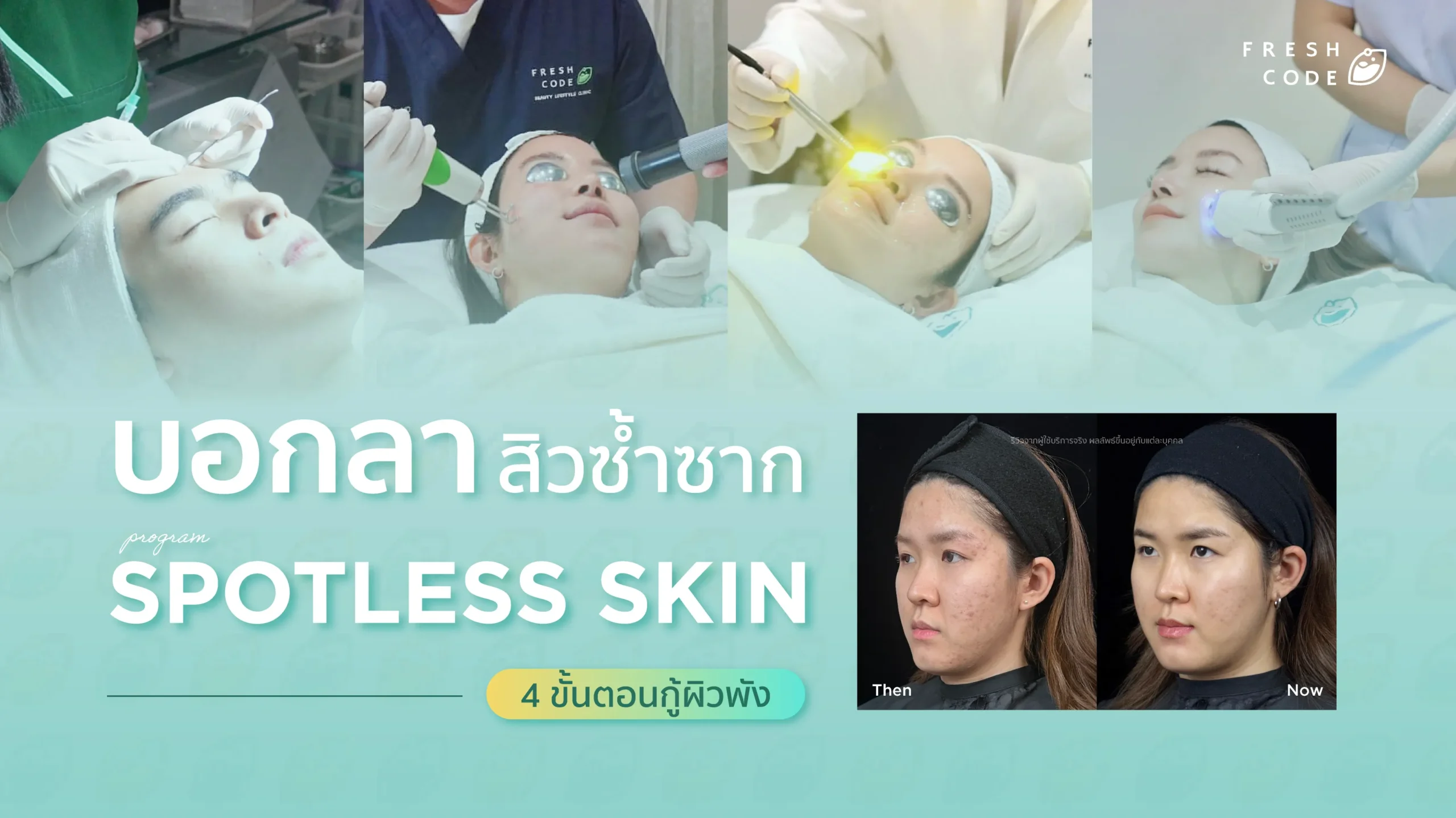 บอกลาวงจรสิวซ้ำซาก เปิด 4 ขั้นตอนกู้ผิวพัง คืนความมั่นใจด้วยโปรแกรม Spotless Skin