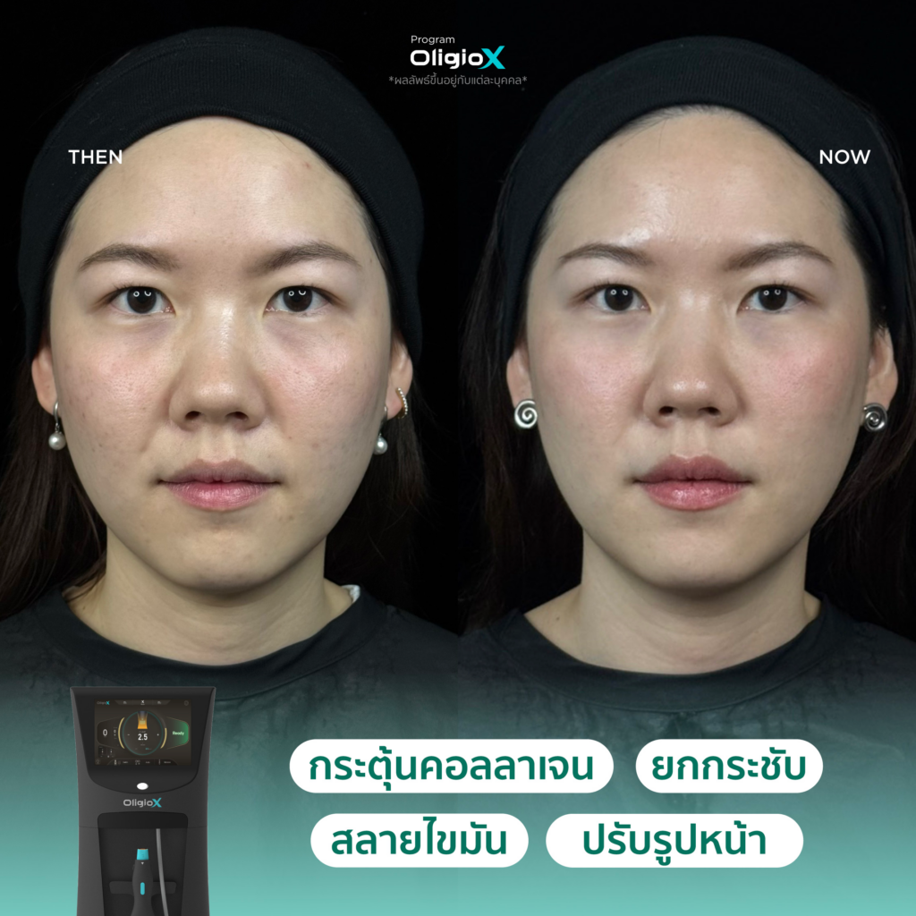 ผลลัพธ์หลังทำ OligioX