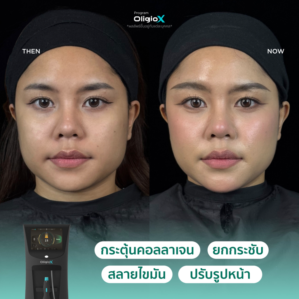 ผลลัพธ์หลังทำ OligioX