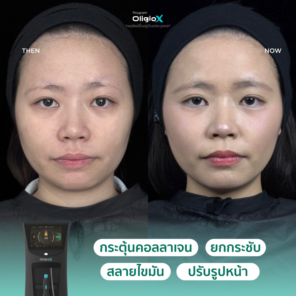 ผลลัพธ์หลังทำ OligioX