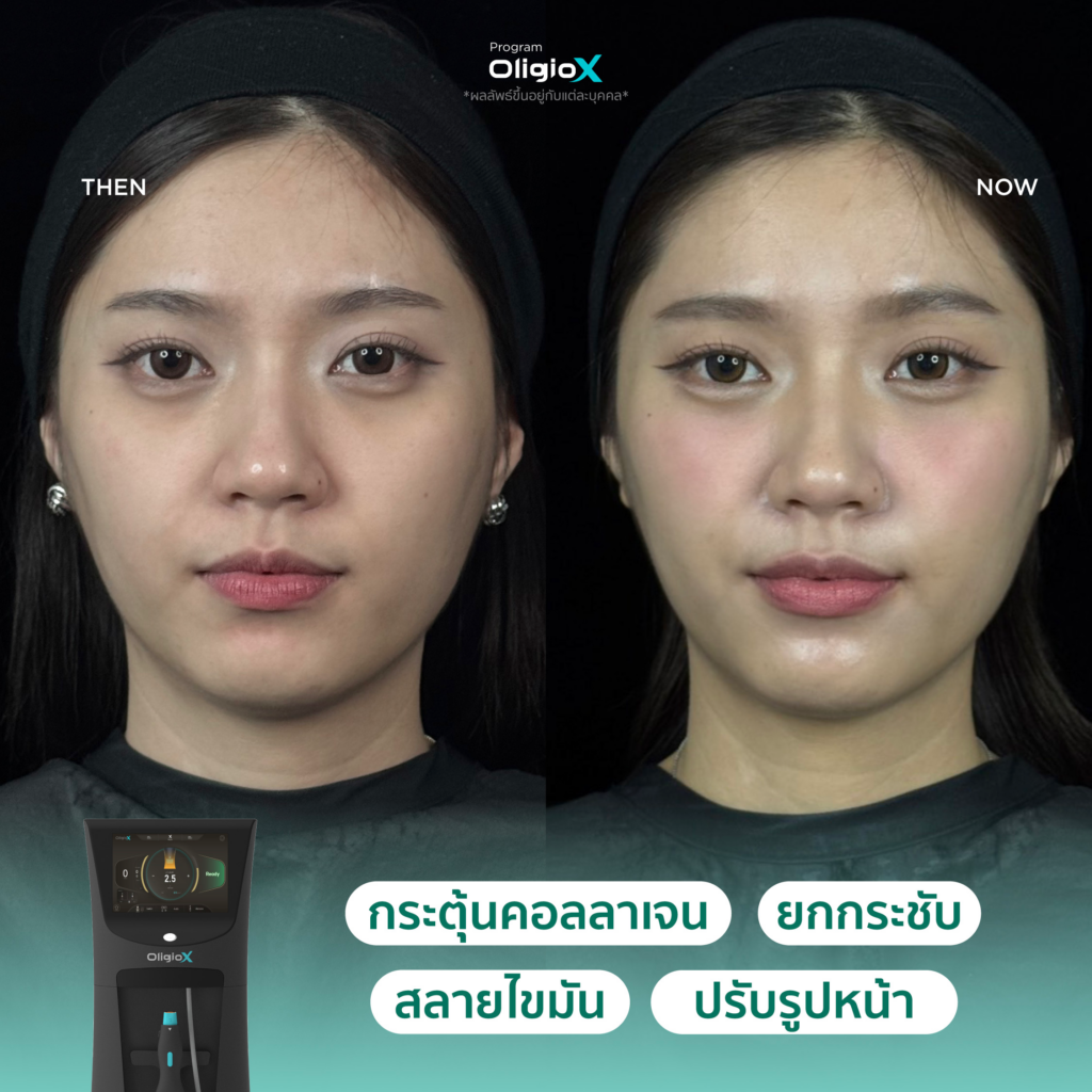 ผลลัพธ์หลังทำ OligioX