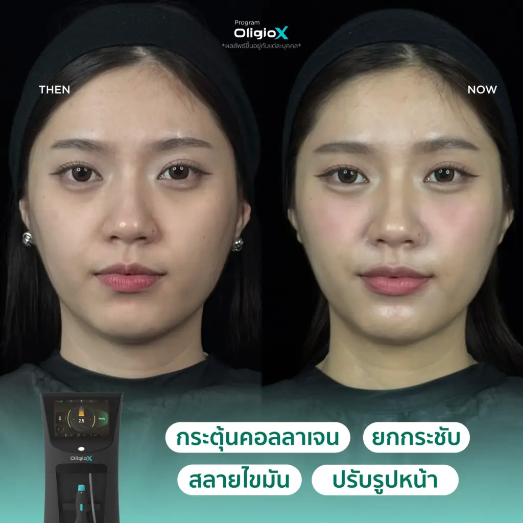 รีวิวผลลัพธ์หลังทำ Oligio X ภาพที่ 4