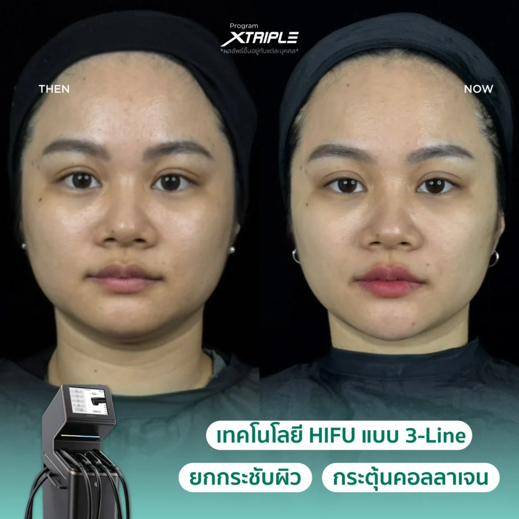 รีวิว XTriple ก่อนและหลังทำบริเวณกรอบหน้าที่ Fresh Code Clinic