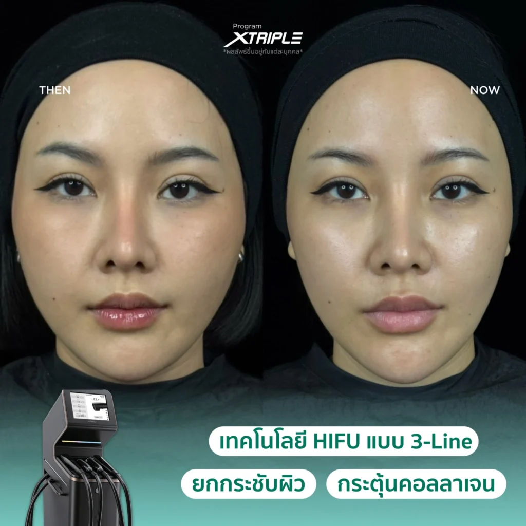 รีวิว XTriple ก่อนและหลังทำบริเวณกรอบหน้าที่ Fresh Code Clinic 1