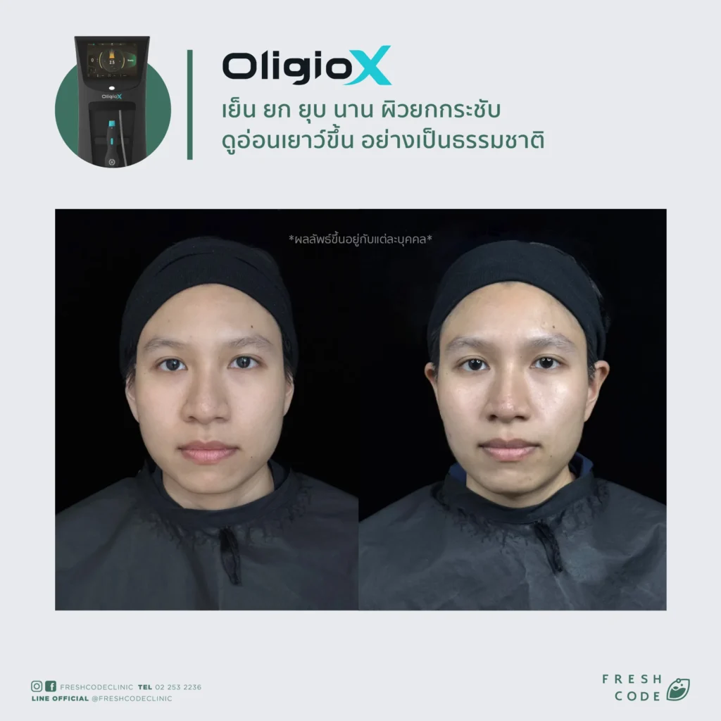 รีวิว Oligio X