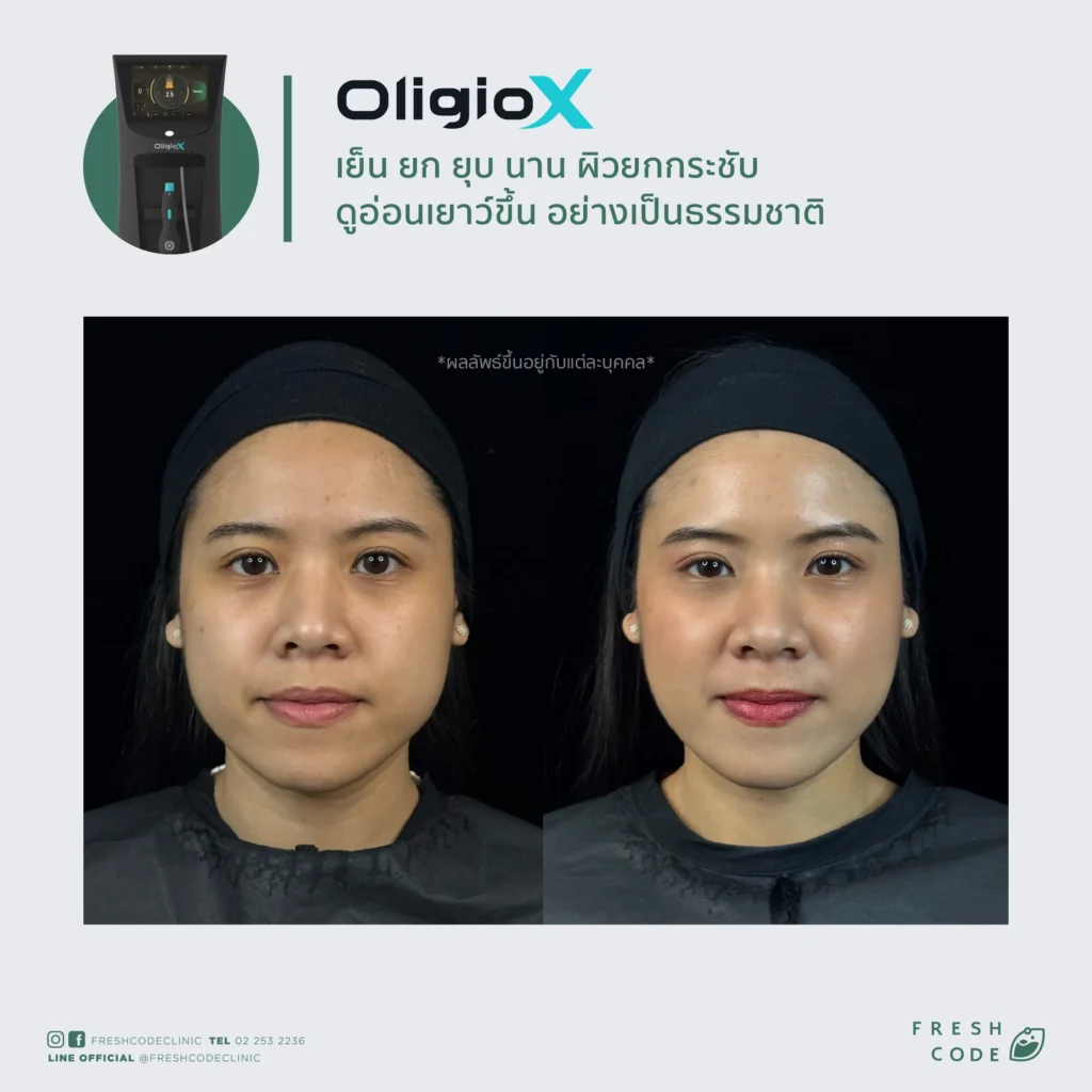 รีวิว Oligio X