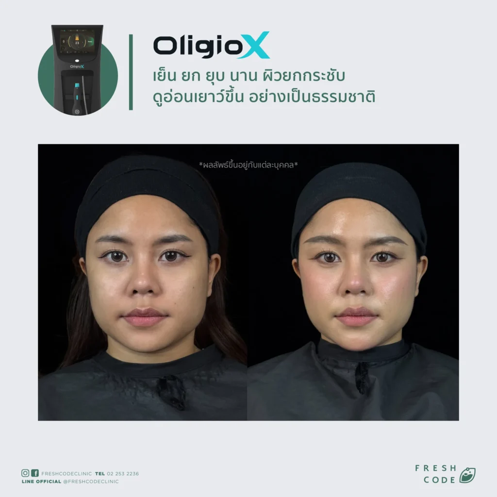 รีวิว Oligio X